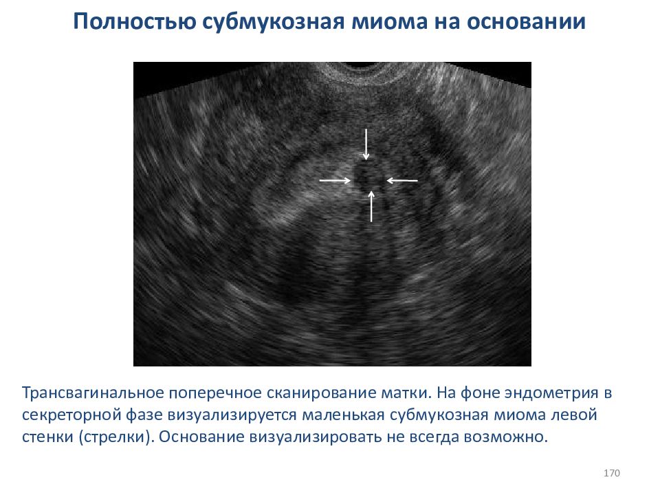 Эндометрия узлов. УЗИ признаки субмукозного узла. Шеечная миома матки УЗИ.