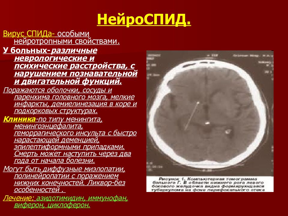 Вич энцефалопатия. Неврологические синдромы при НЕЙРОСПИДЕ. Поражение головного мозга при СПИДЕ. Нейроспид презентация. Нейроспид этиология.
