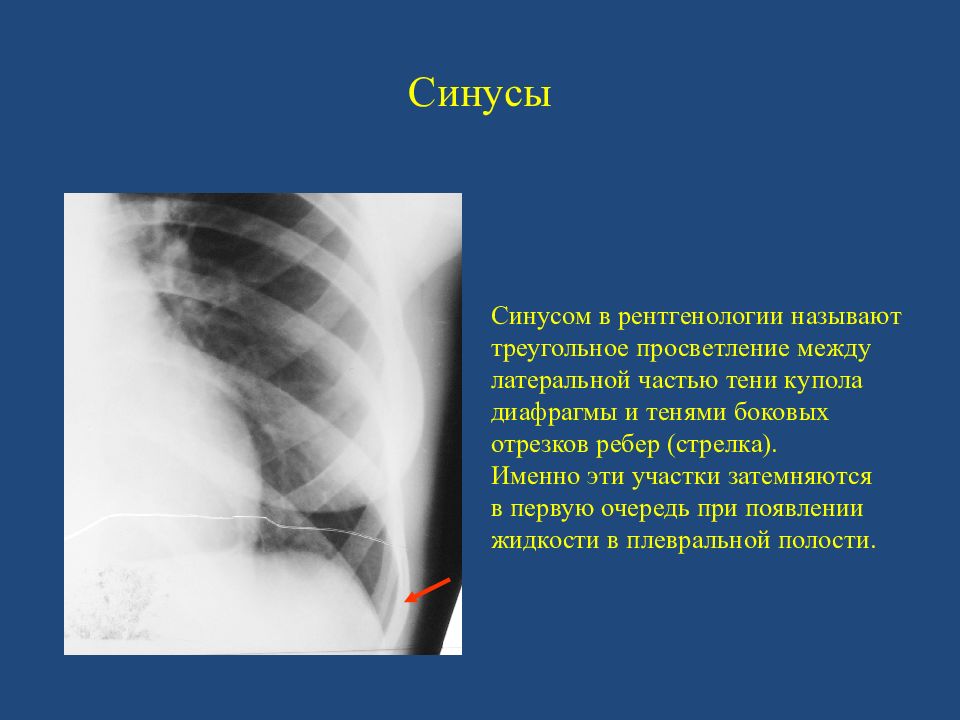 Кардиодиафрагмальный синус. Облитерирован синус легких рентген. Синусы легкого на рентгене. Затемнение реберно-диафрагмальных синусов.