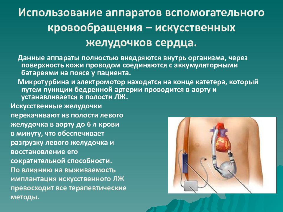 Искусственное кровообращение. Аппарат вспомогательного кровообращения. Вспомогательное искусственное кровообращение. Система вспомогательного кровообращения. Методы вспомогательного кровообращения.