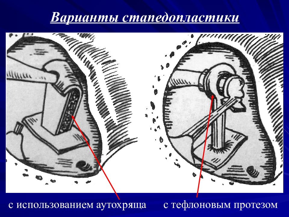 Стапедопластика. Отосклероз операция стапедопластика. Тефлоновый протез стапедопластика. Поршневая стапедопластика.