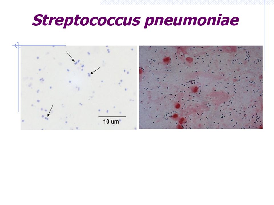 Streptococcus pneumoniae. Streptococcus pneumoniae в зеве у взрослого. Streptococcus pneumoniae в носу 10 в 3 степени. Streptococcus pneumoniae 10 в 7 в мокроте.