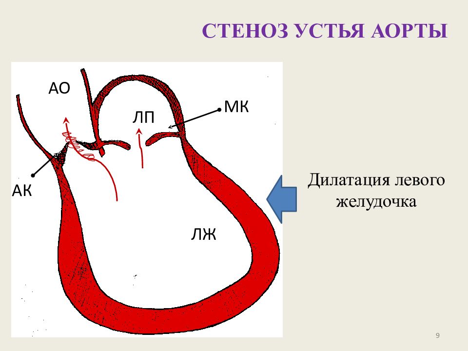 Аортальный стеноз что это такое. Стеноз аортального клапана гемодинамика. Стеноз аортального клапана схема. Стеноз устья аорты и аортальный стеноз.