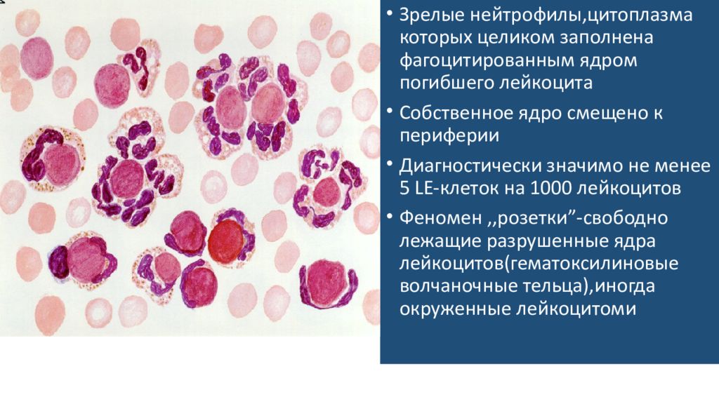 Le-клетки волчаночные клетки. Le клетки при системной красной волчанке. ле клетки при красной волчанке. Le клетки микроскопия. Le клетки системной красной волчанки.