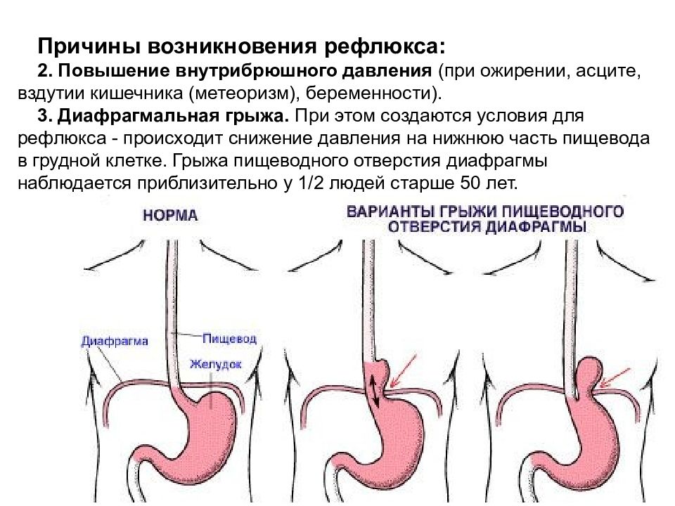 Гастроэзофагеальная рефлюксная болезнь у детей презентация