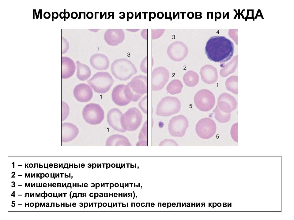 Гипохромия железодефицитная анемия