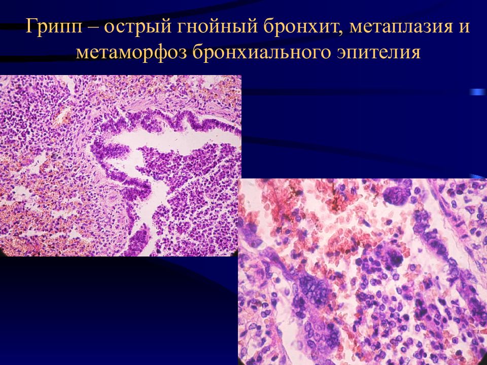 Гнойный бронхит. Респираторно синцитиальная инфекция патанатомия. Респираторная вирусная инфекция патанатомия. РС-инфекция это патанатомия. Вирусные инфекции патанатомия.