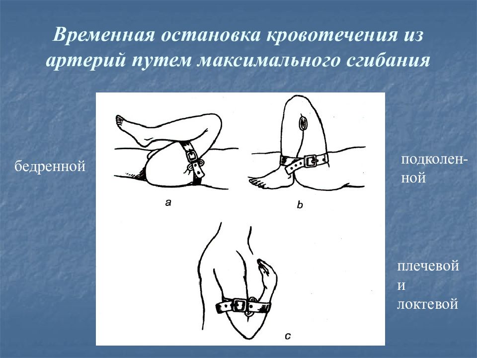 Плечевая артерия кровотечение. Классификация кровотечений хирургия. Кровотечение общая хирургия.