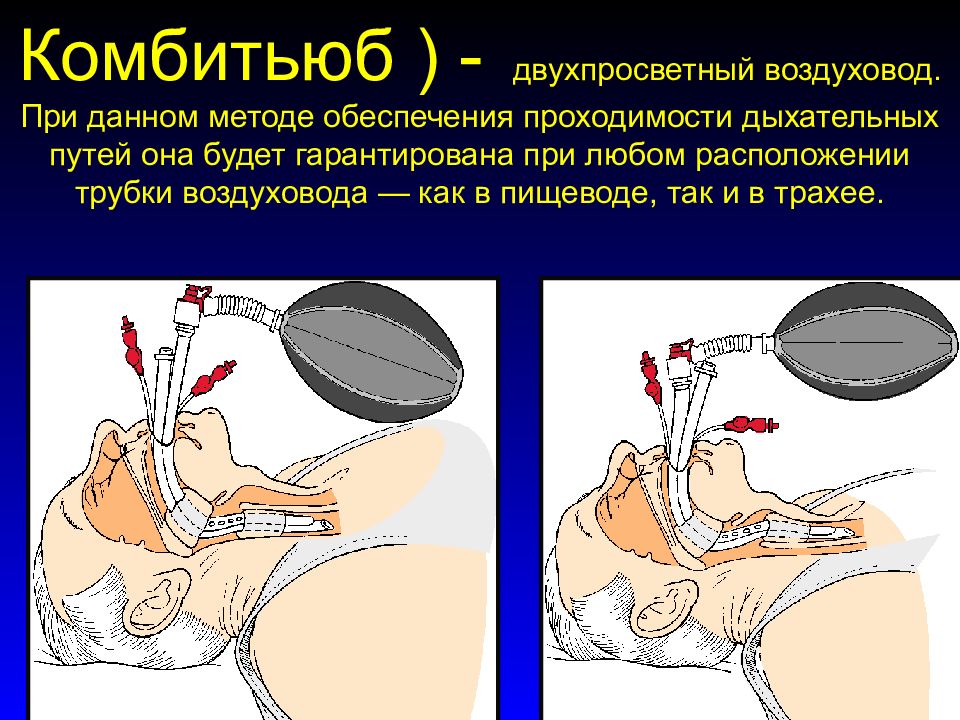 Интубация трахеи презентация