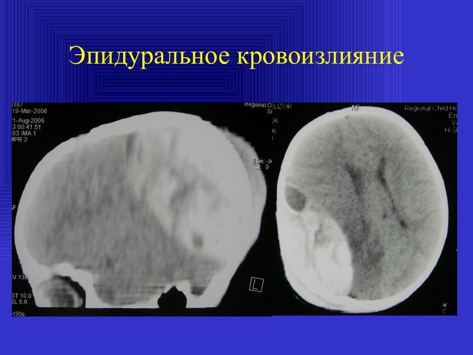 Кровоизлияние головного мозга новорожденного