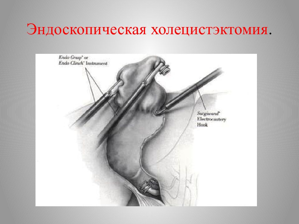 Перенесенная холецистэктомия. Лапароскопическая холецистостомия. Холецистэктомия эндоскопические операции. Лапаротомная холецистэктомия.