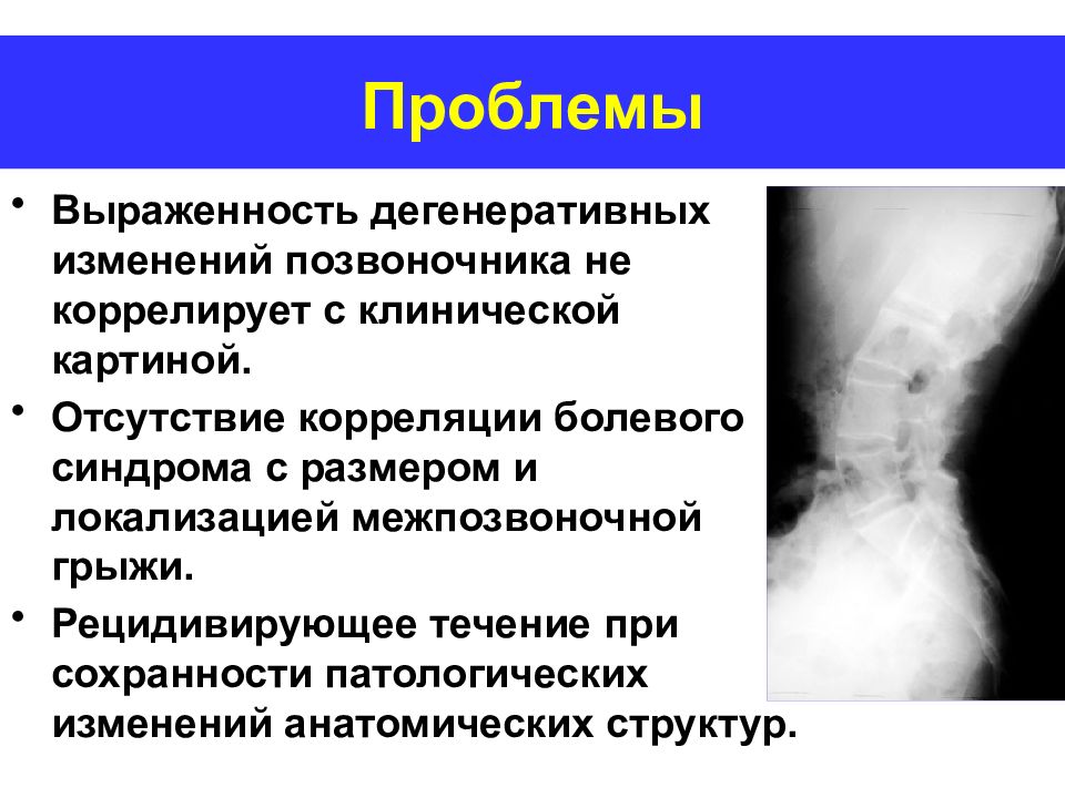 Дистрофическое изменение костей. Дегенеративные изменения позвоночника. Дистрофические изменения позвонков. Для поправки позвоночника. Изменения в позвоночнике дегенеративного характера.