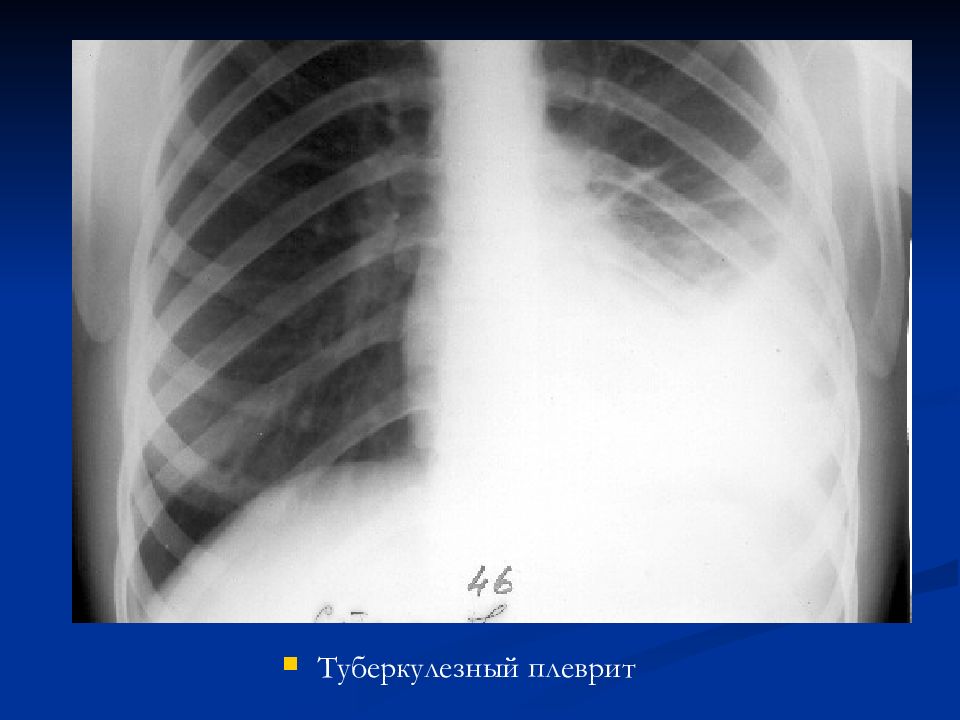 Туберкулез плеврит презентация