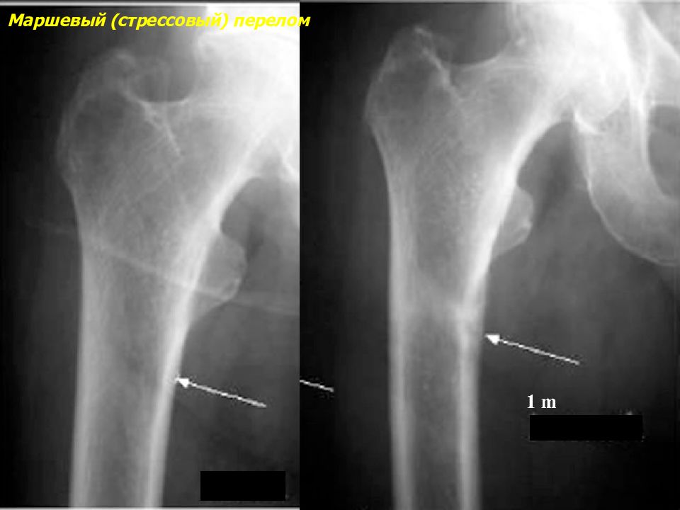 Маршевый стрессовый перелом. Рентгеносемиотика переломов костей. Стрессовый перелом плеча.
