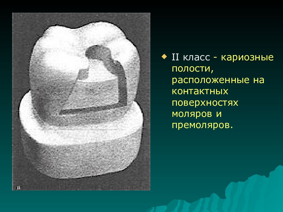 Классы по блэку в стоматологии в картинках