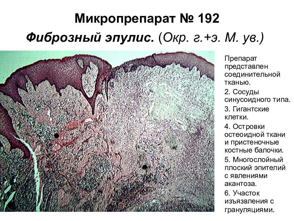 Представить препарат. Фиброзный эпулис микропрепарат. Фиброзный эпулис гистология. Эпителий проксимального канальца почки.