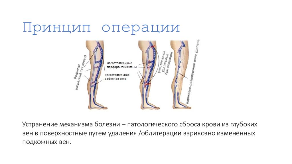 Принципы операции. Клапаны перфорантных вен. Несостоятельная перфорантная Вена. Перфорантные вены голени. Операции при варикозной болезни.