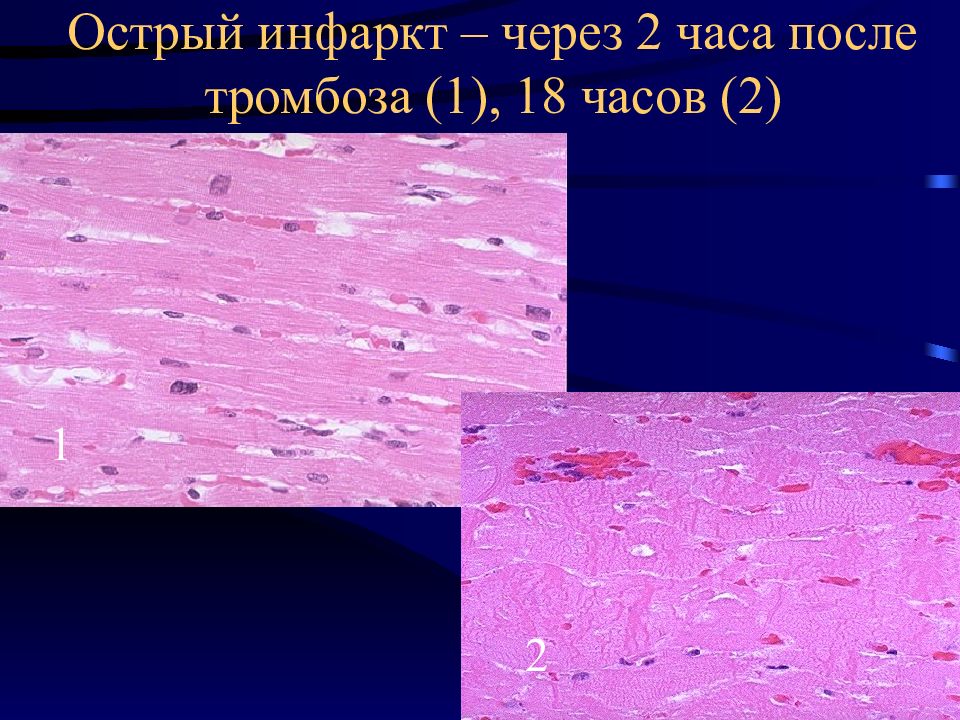 Ибс патологическая анатомия презентация