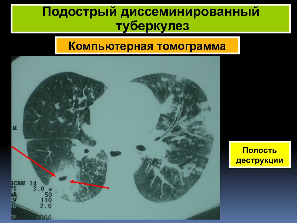 Диссеминированный туберкулез фаза инфильтрации. Милиарный туберкулез кт. Хронический диссеминированный туберкулез легких кт. Диссеминированный инфильтративный туберкулез. Диссменированны йтуберкулез на кт.