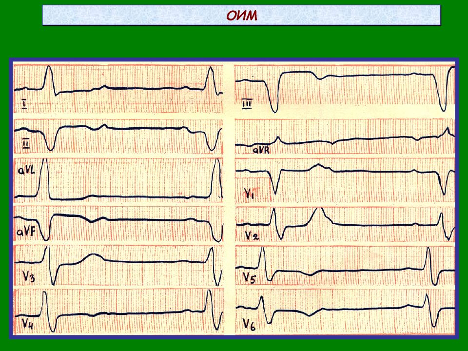 Заднебазальный инфаркт миокарда ЭКГ. ЭКГ при заднебазальном им. Электрокардиографические признаки заднебазального инфаркта.