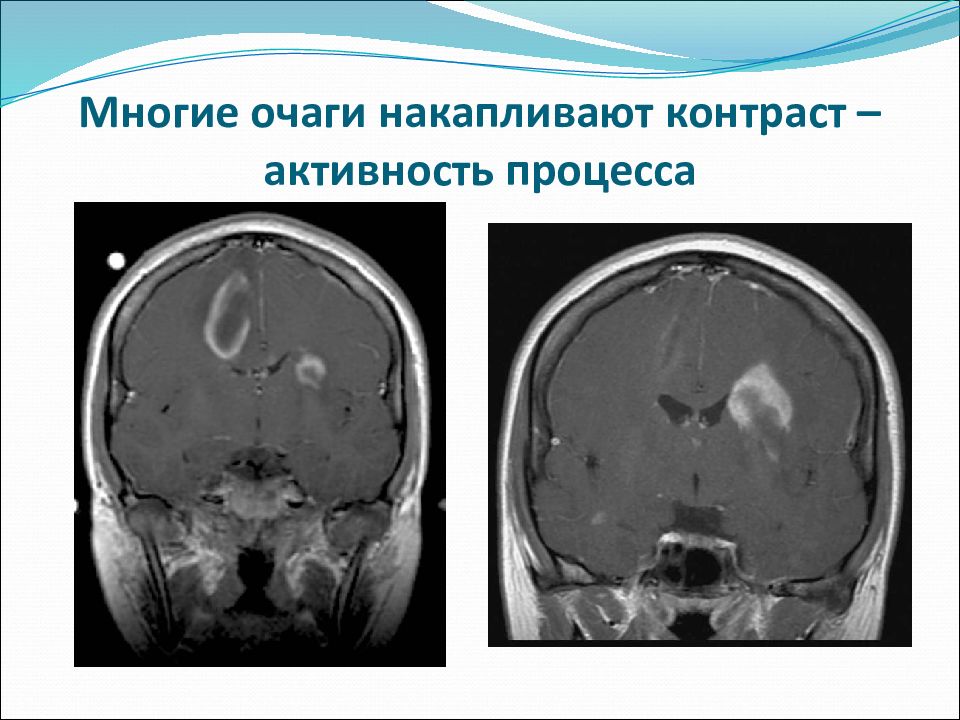 Острый рассеянный энцефаломиелит презентация