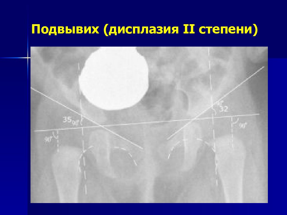 Дисплазия 2 степени что это такое. Фиброзная дисплазия рентген. Дисплазия под вивых. Фибромускулярная дисплазия.