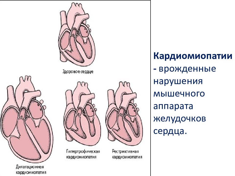 Кардиомиопатия сердца что это