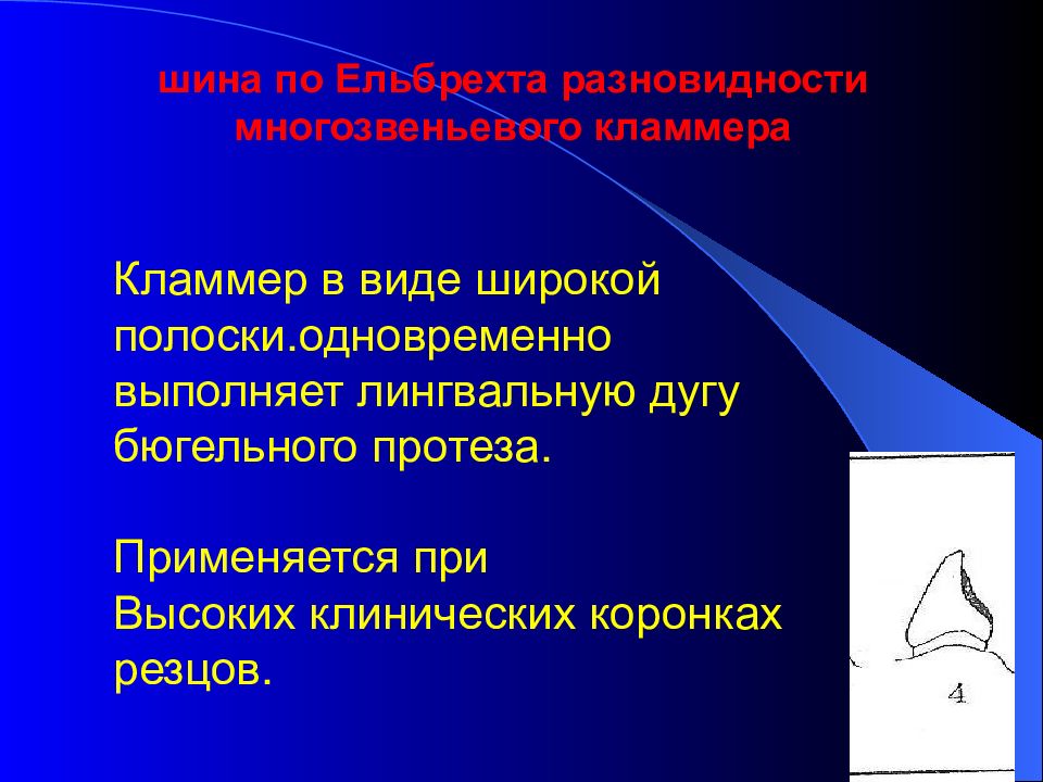 Наложение сложных шин и шин протезов презентация