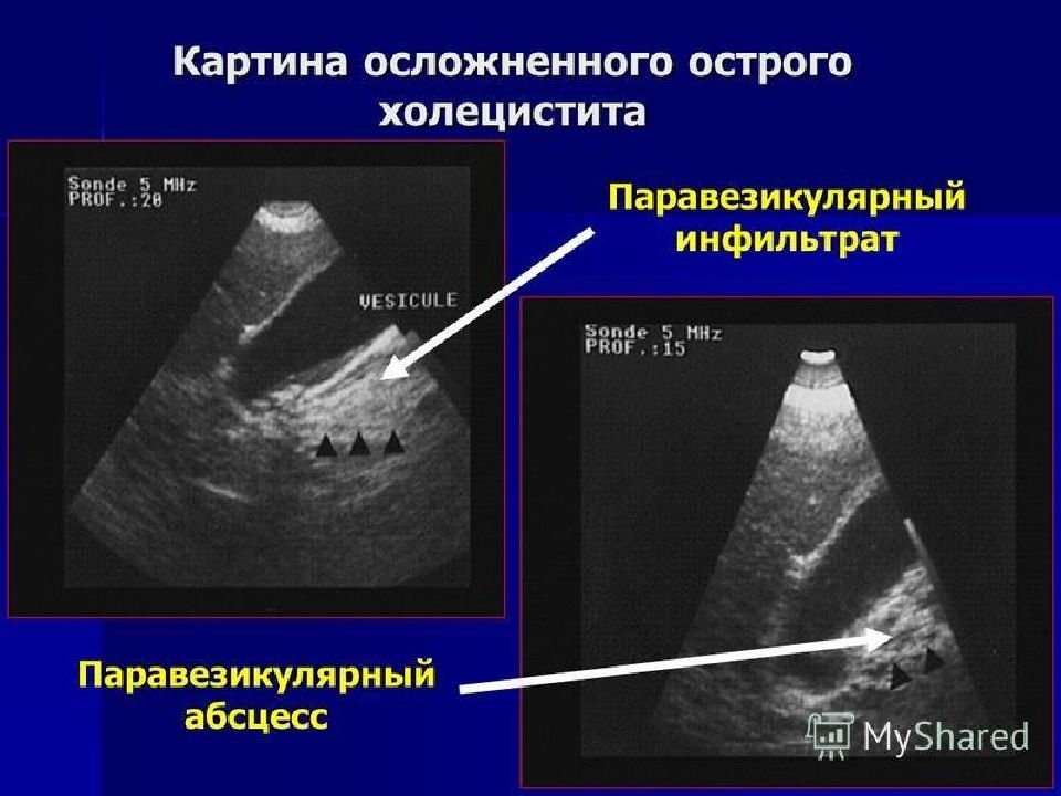 При водянке желчного пузыря в эхографической картине обычно не отмечается