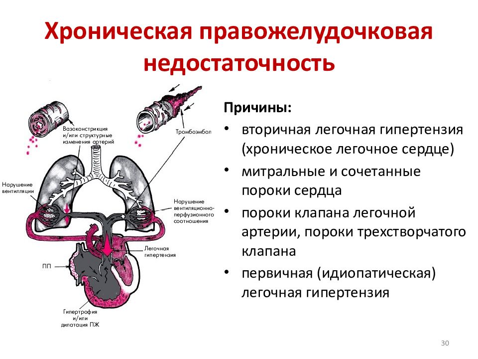 Левожелудочковая недостаточность презентация