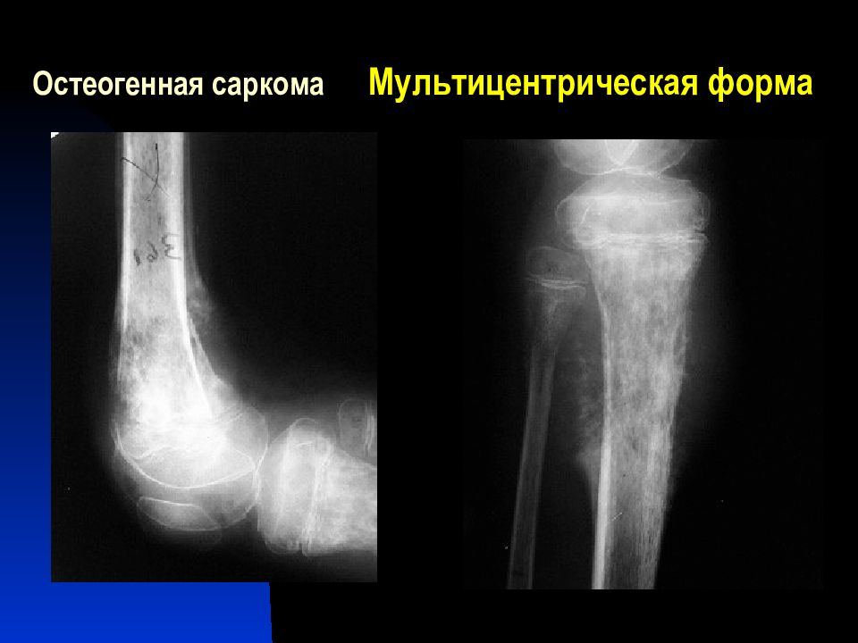 Особенности сарком. Саркома голени рентген. Параоссальная остеогенная саркома.