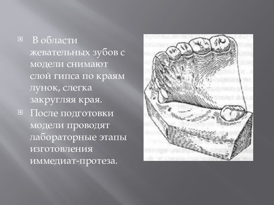 Схема сошлифовывания гипса на модели при изготовлении иммедиат протеза