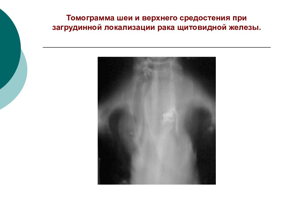 Злокачественные опухоли щитовидной железы презентация