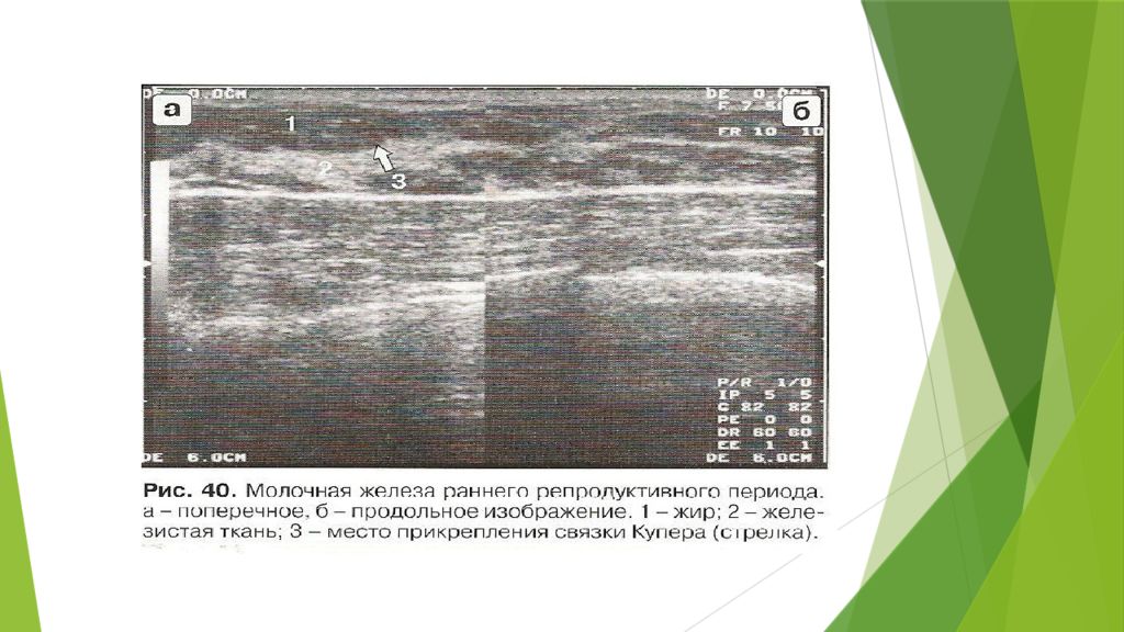 Как подготовиться к узи молочных желез. УЗИ молочной железы презентация. УЗИ молочных желез в репродуктивном периоде. УЗИ молочной железы в раннем репродуктивном периоде. Трактовка данных УЗИ молочной железы.