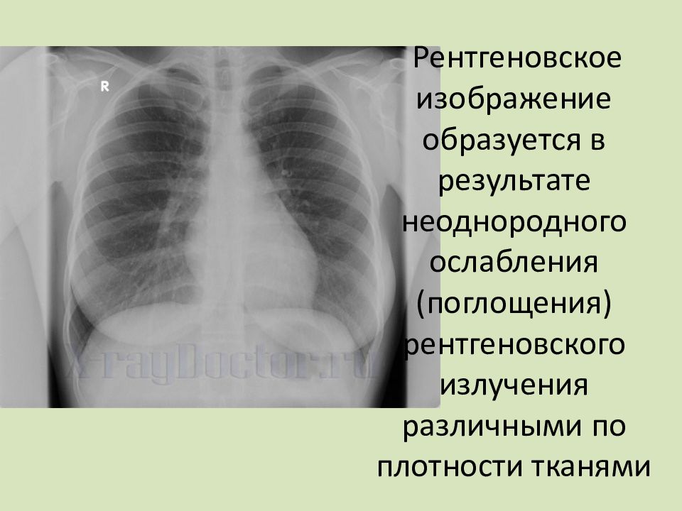 Рентгеновское изображение получают