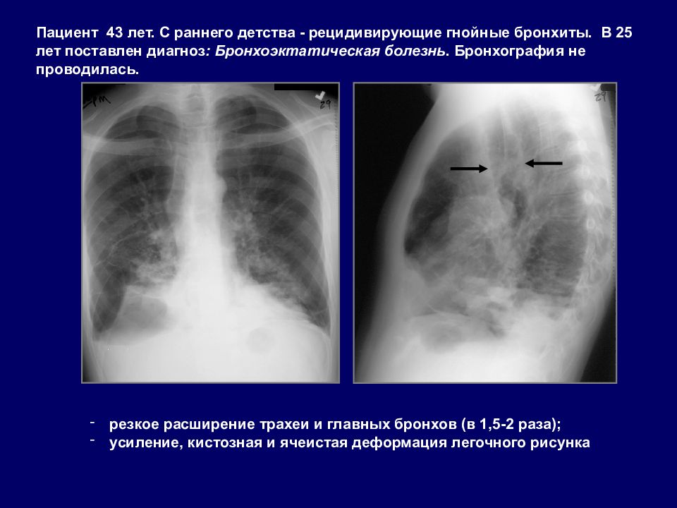 Легочный рисунок усилен деформирован. Ячеистая деформация легочного рисунка. Легочный рисунок деформирован. Легочный рисунок ячеисто деформирован. Ячеистая перестройка легочного рисунка.