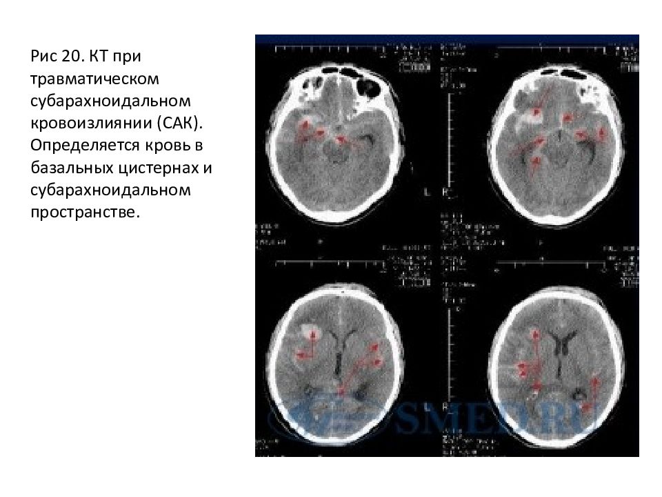 Минимальное расширение субарахноидальных. Субарахноидальное кровоизлияние кт. Субарахноидальная гематома. Субарахноидальное кровоизлияние картинка. Травматическое субарахноидальное кровоизлияние.