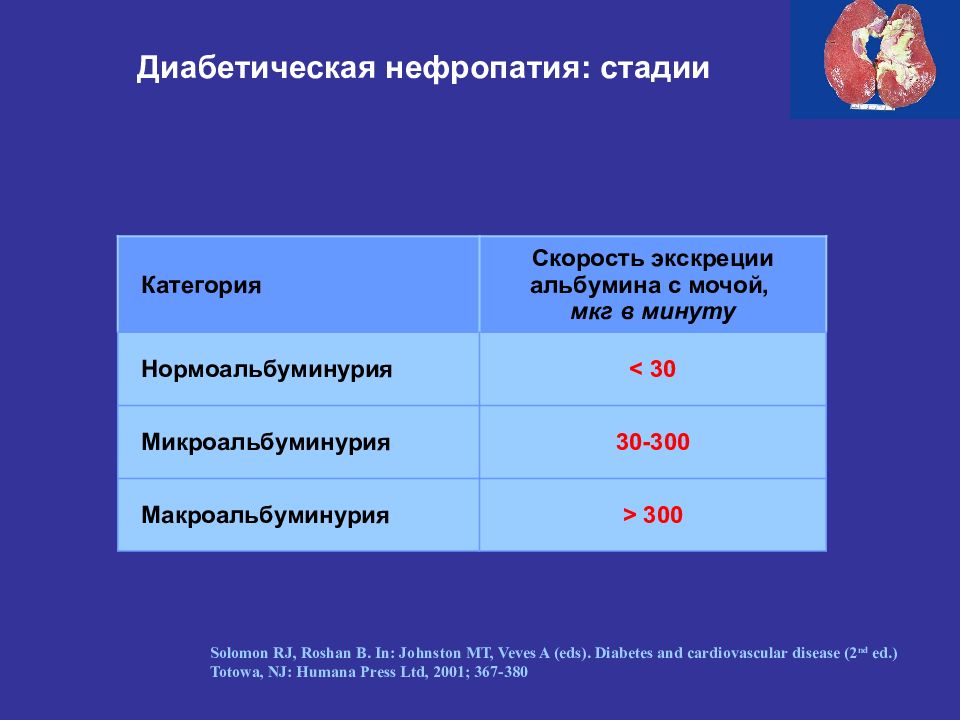 Стадии диабета. Диабетическая нефропатия стадии и степени. Диабетическая нефропатия микроальбуминурия. Диабетическая нефропатия 2а стадии СКФ. Клинический признак диабетической нефропатии.