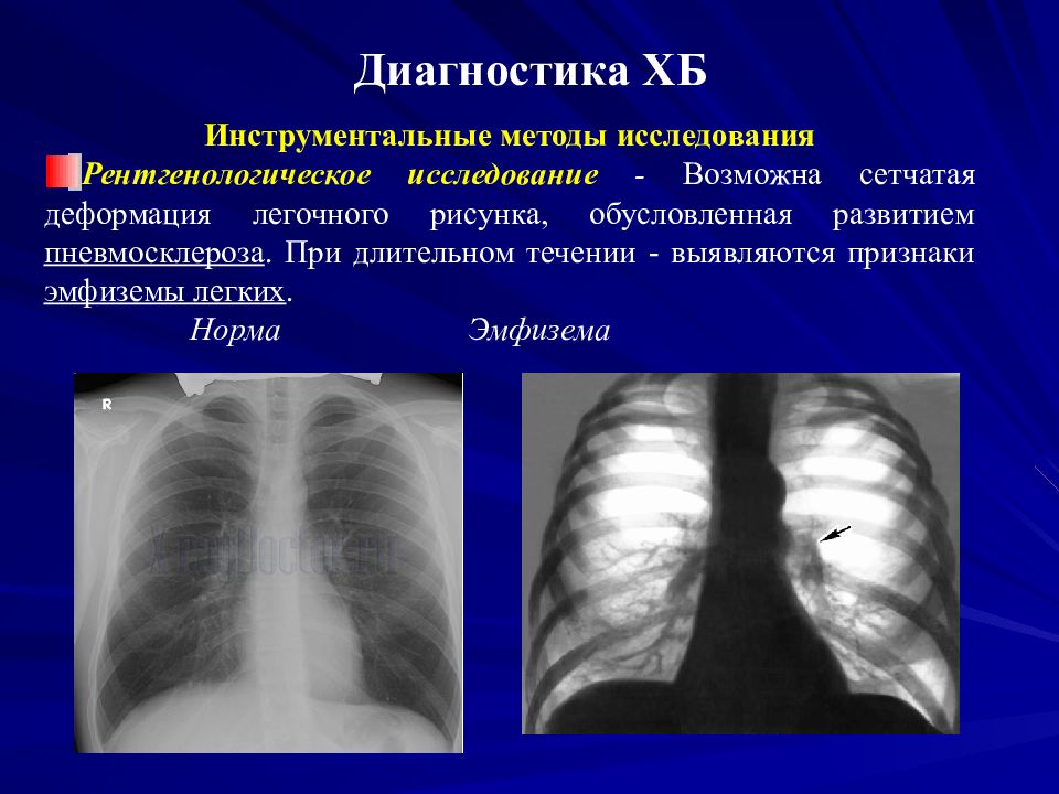 Что такое усиление легочного рисунка на рентгене у ребенка