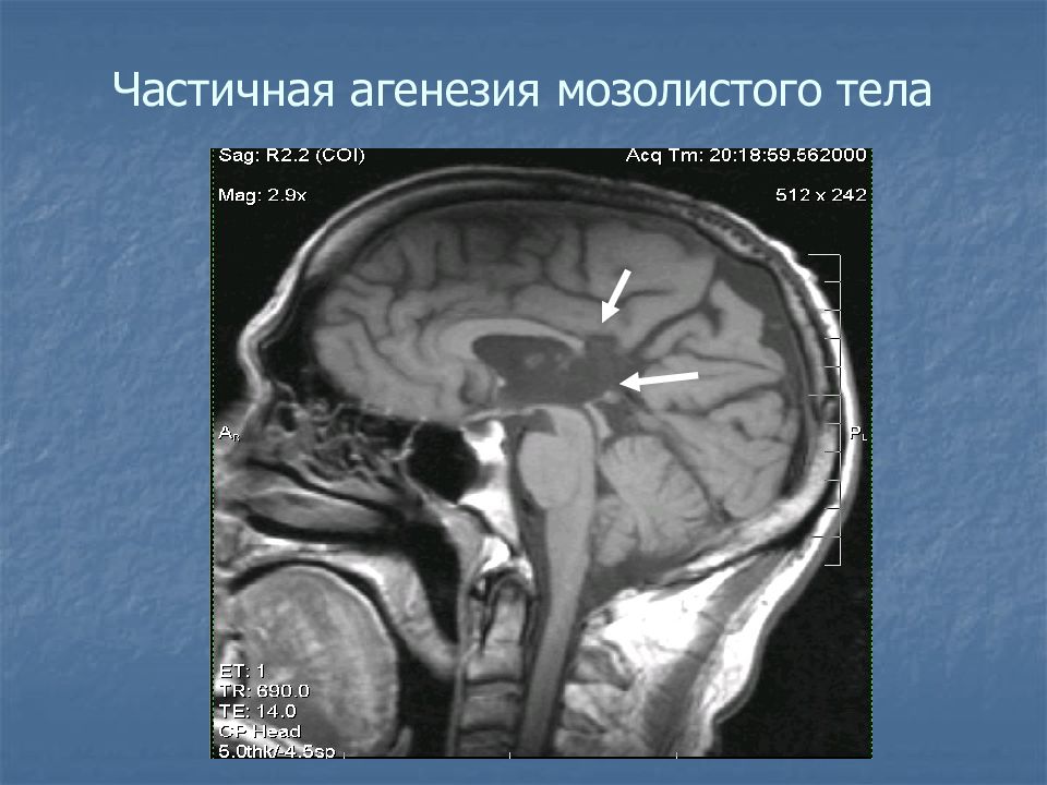 Гипоплазия правой головного мозга. Агенезия мозолистого тела НСГ. Врожденная аномалия мозолистого тела что это такое. Гипоплазия мозолистого тела УЗИ. Агенезия мозолистого тела нейросонография УЗИ.
