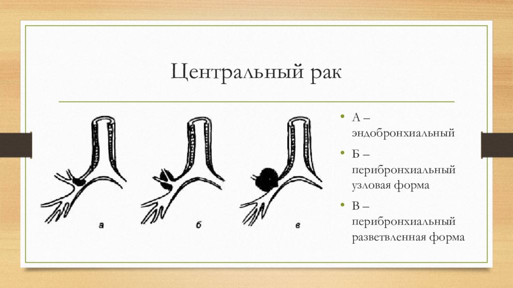 Центральный рак. Перибронхиальный рост опухоли. Эндобронхиальный рост. Эндобронхиальный опухоли легкого. Экзобронхиальный и перибронхиальный.