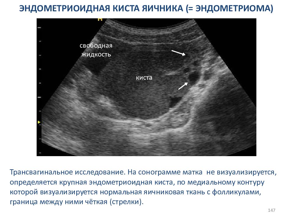 Схема лечения кисты яичника