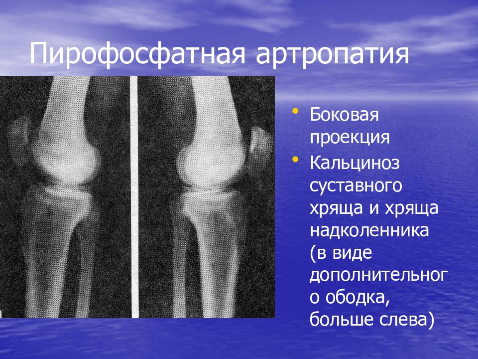 Пирофосфатная артропатия