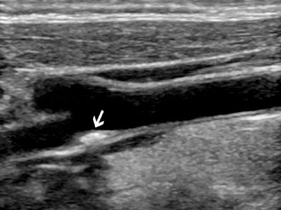 Чем отличается узи сосудов от. Атеросклеротическая бляшка УЗИ. Атеросклероз бляшка УЗИ. Атеросклероз бедренной артерии на УЗИ. Атеросклероз артерий нижних конечностей на УЗИ.