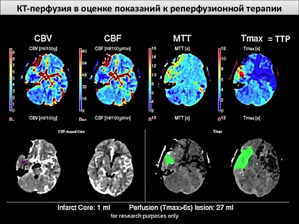 Реперфузионная карта образец