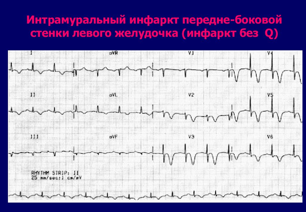Изменение передней стенки левого желудочка. Интрамуральный инфаркт миокарда на ЭКГ. ЭКГ при интрамуральном инфаркте. Острый субэндокардиальный инфаркт миокарда ЭКГ. Трансмуральный инфаркт миокарда на ЭКГ.