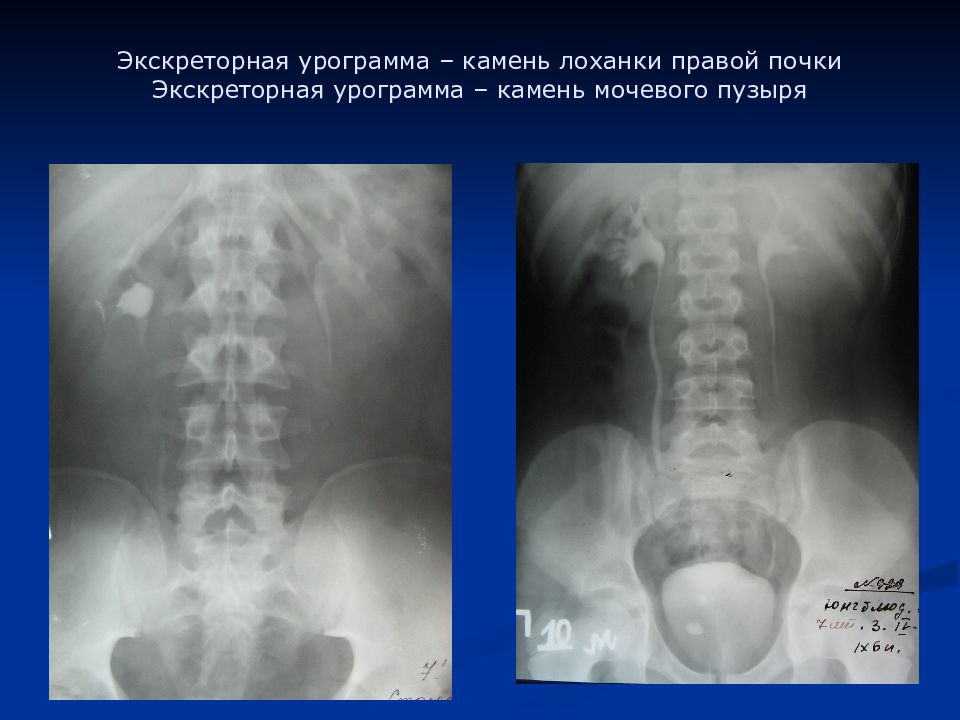 Конкременты лоханки. Экскреторная урография почек рентген. Мочекаменная болезнь экскреторная урография. Экскреторная урография коралловидный камень.