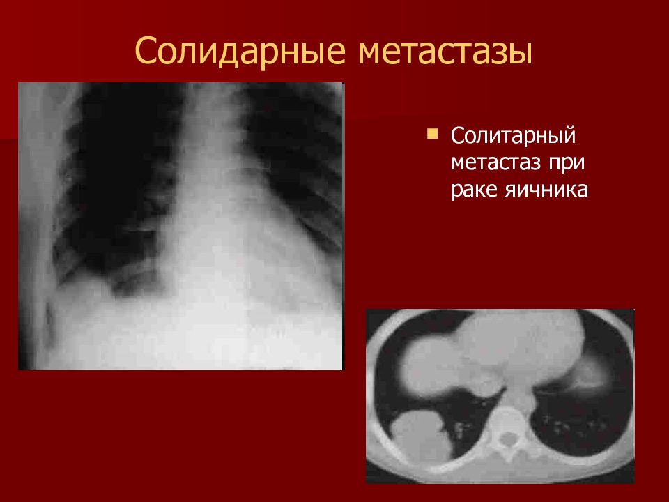 Метастазы при раке легких. Солитарный метастаз в легком кт. Опухоли яичников метастазирование. Метастазы рентгенодиагностика. Лучевые симптомы метастазов.