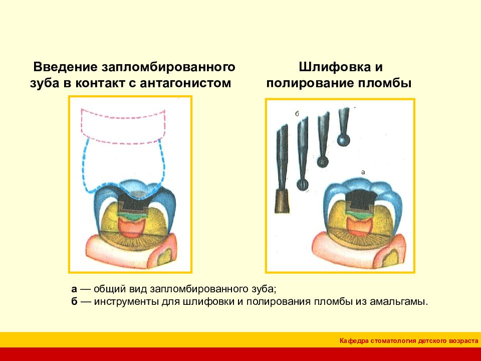 Элементы кариозной полости