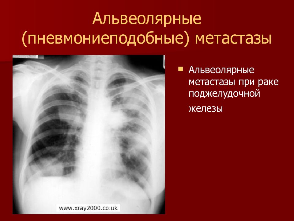 Метастазы при раке легких. Рентгенодиагностика опухолей легких. Рентгенодиагностика метастатических опухолей лёгких.. Лучевая картина опухолей легких. Пневмониеподобное метастазирование.